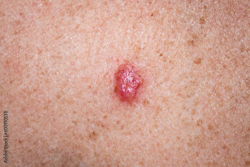 Young female 30s close up of chest prior to applying imiquimod cream medication to basal cell carcinoma. photo
