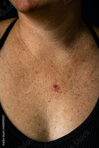 Vertical view of ulcerated sore superficial basal cell carcinoma red discoloration on young 30s caucasian female chest. photo