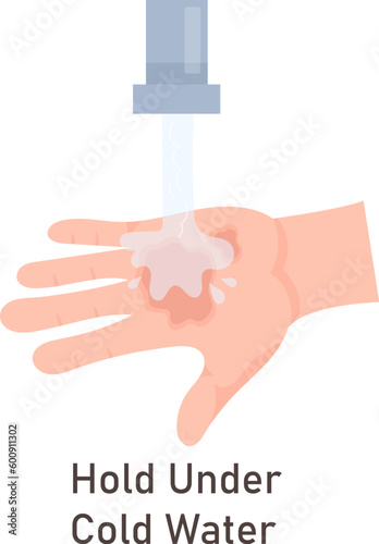 Hand Injuries Treatment With Cold Water