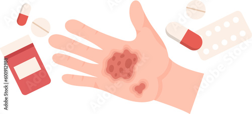 Hand Injuries Treatment With Pain Reliever
