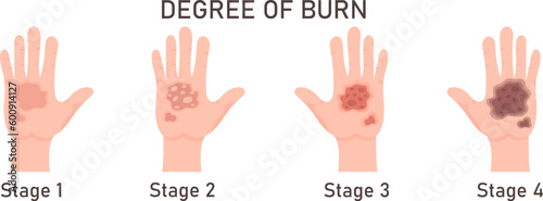 Degree Of Skin Burn