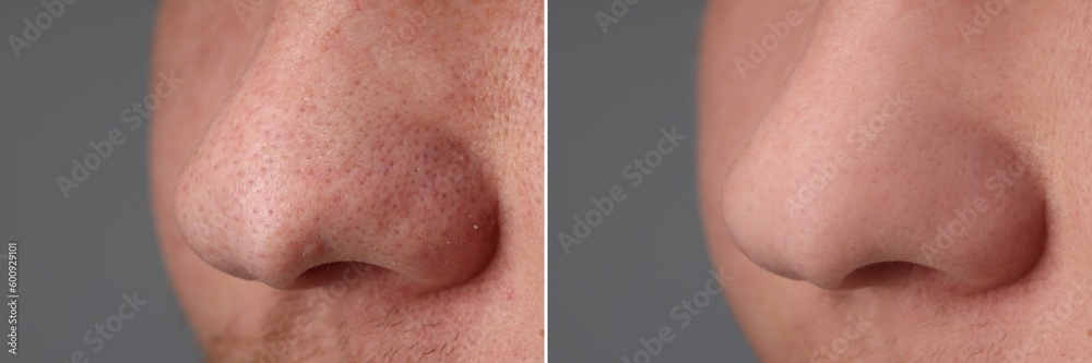 Before and after acne treatment. Photos of man on grey background, closeup. Collage showing affected and healthy skin