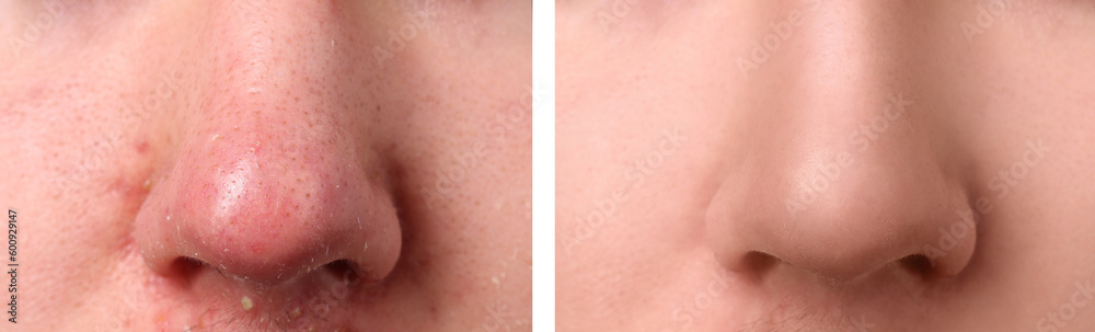 Photos of man before and after acne treatment, closeup. Collage showing affected and healthy skin Photos of man before and after acne treatment, closeup. Collage showing affected and healthy skin