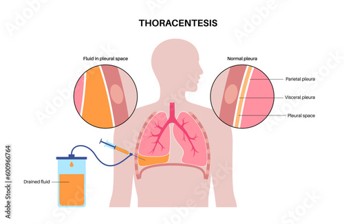 Thoracentesis medical procedure