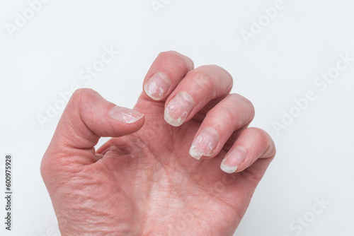 Bitten and broken nails without manicure with overgrown cuticle of nail and a damaged nail plate after applying gel polish