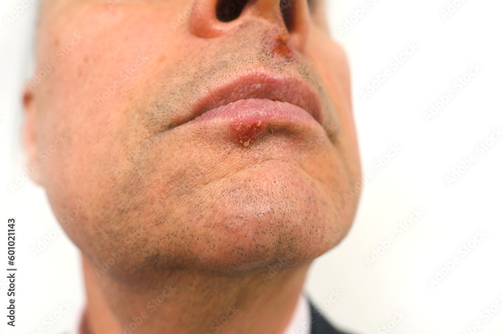 close up part of mature male face, man, senior 60 years old looks carefully examines herpes on lip, under nose, viral disease with specific blisters (vesicles) on skin close up part of mature male face, man, senior 60 years old looks carefully examines herpes on lip, under nose, viral disease with specific blisters (vesicles) on skin