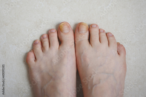Toenails affected by fungal infection. Onychomycosis © Viktoryia