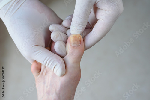 Onychomycosis. Foots with fungus on nails is examined by doctor in gloves