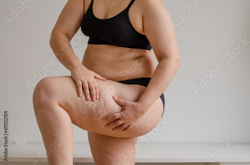fat woman squeezing leg with cellulitis wearing bikini
