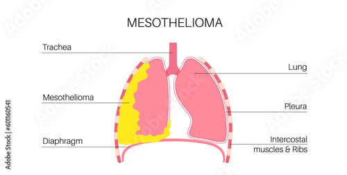 Mesothelioma cancer disease