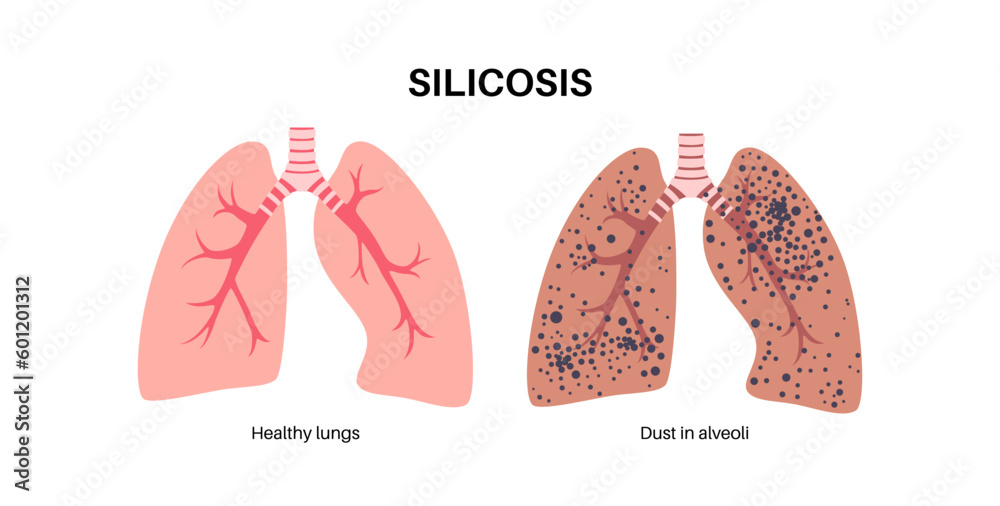 Obraz premium Silicosis dust in lung