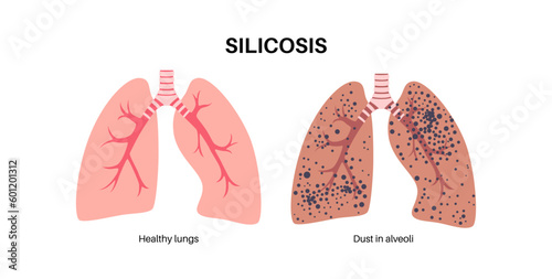 Silicosis dust in lung