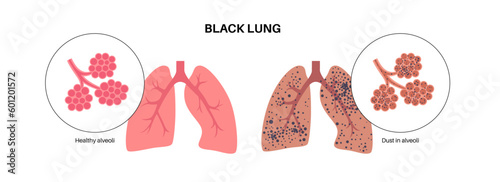 Coal workers disease