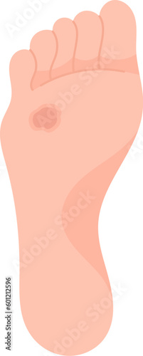 Superlicial Ulcer Foot Disease