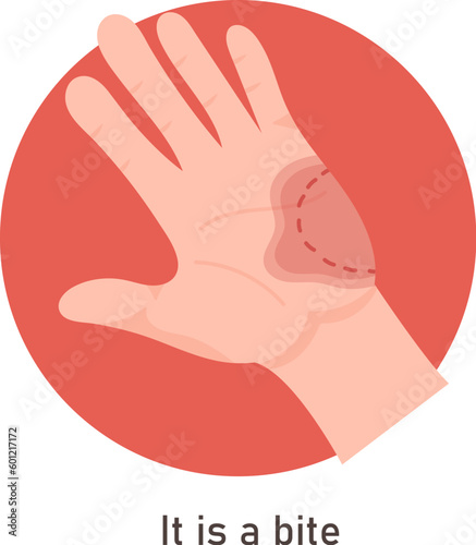 Bite On Hand Symptom