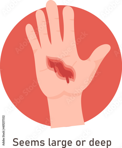 Large And Deep Hand Wound
