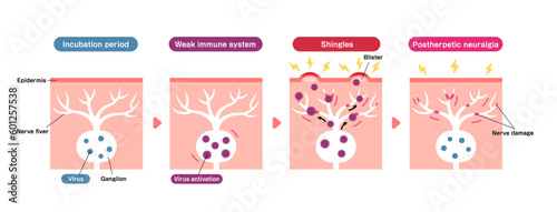 Mechanism of shingles ( herpes zoster ) vector illustration