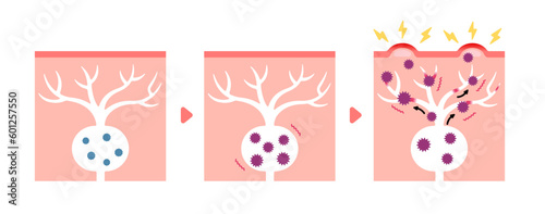 Mechanism of shingles ( herpes zoster ) vector illustration