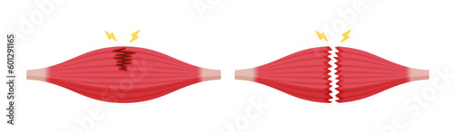Muscle rupture vector illustration (partial and complete tears )