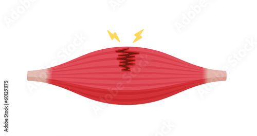 Muscle rupture vector illustration (partial tear )
