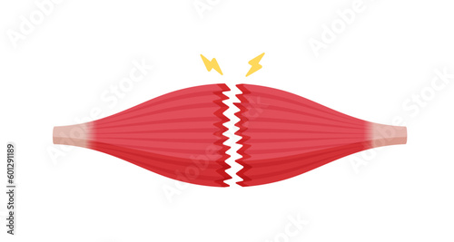Muscle rupture vector illustration ( complete tear )