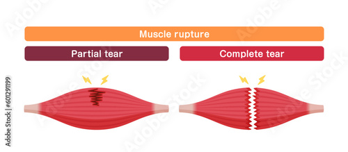 Muscle rupture vector illustration (partial and complete tears )