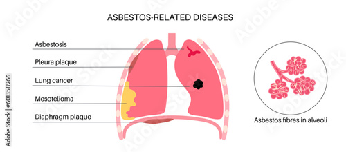 Asbestos related diseases
