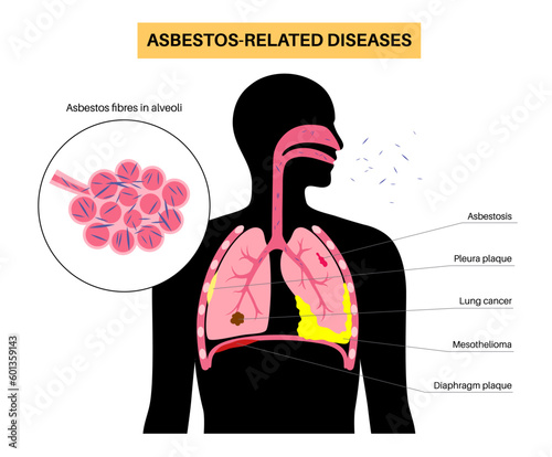 Asbestos related diseases