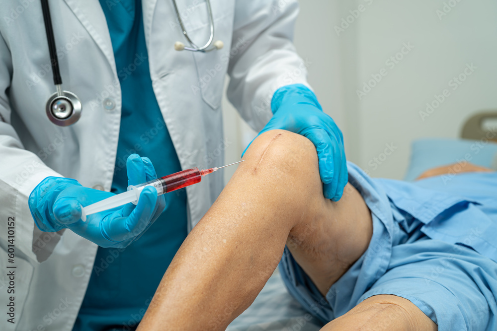 Φωτογραφία Asian elderly woman patient show her scars surgical total knee joint replacement Suture wound surgery arthroplasty in hospital, healthy strong medical concept