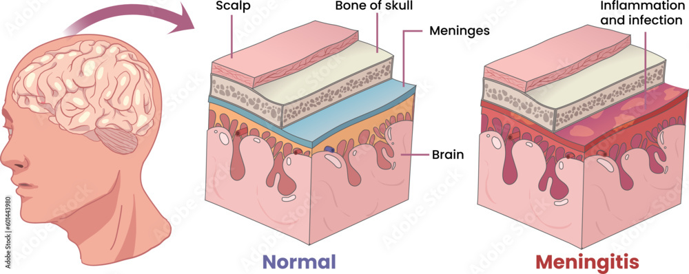 illustration of meningitis, inflammation membranes covering the brain ...