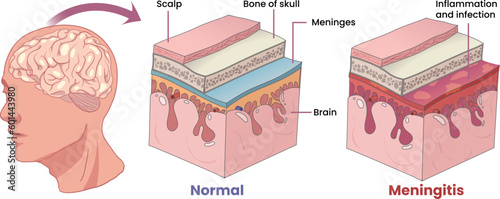 illustration of meningitis, inflammation membranes covering the brain photo