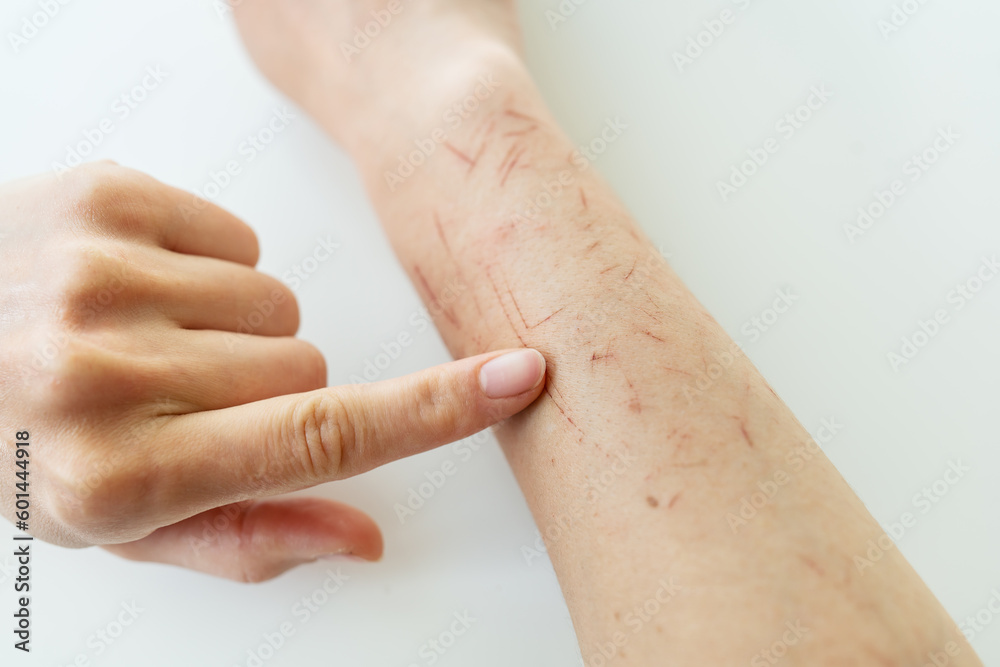 The doctor examines the hand, the person is covered in scratches ...