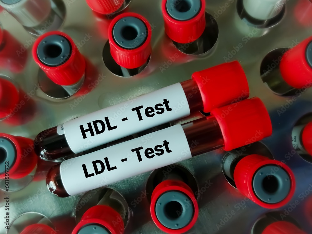Blood samples isolated for HDL Cholesterol (good cholesterol) and LDL