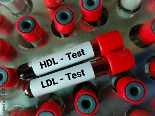 Blood samples isolated for HDL Cholesterol (good cholesterol) and LDL Cholesterol (bad cholesterol) test, Cardiovascular disease diagnosis. photo