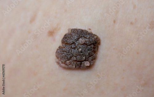 Nevus close-up. Mole on human skin. Irregular birthmark. photo