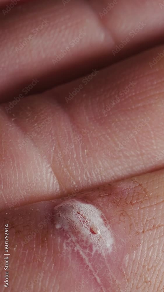 Treatment of the wound on the finger with hydrogen peroxide. macro Vertical video. Treatment of the wound on the finger with hydrogen peroxide. macro Vertical video.