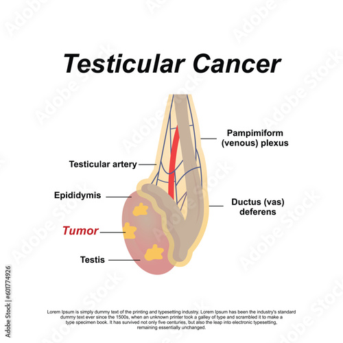A Male Anatomy of Testicular Cancer