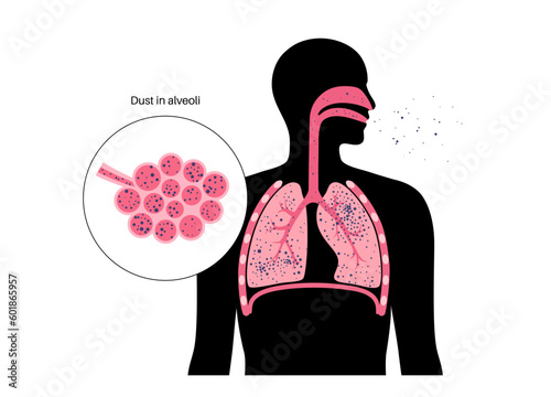 Pneumoconiosis lung disease