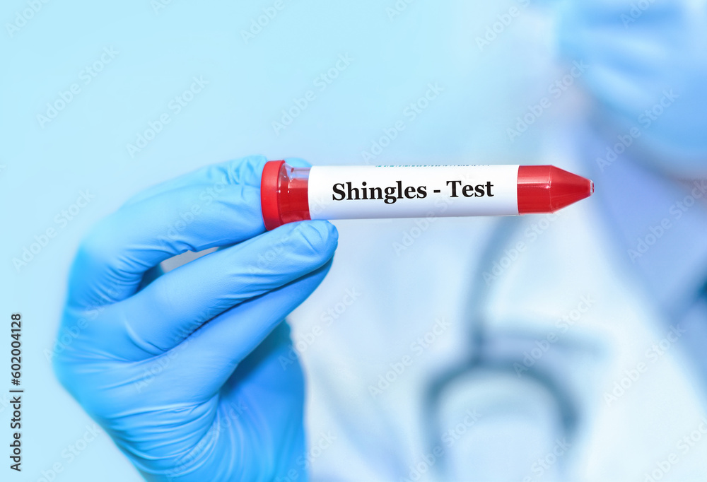 Doctor holding a test blood sample tube positive with Shingles test. Doctor holding a test blood sample tube positive with Shingles test.