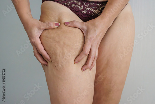 White woman's legs with flab and cellulite