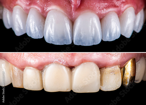 creating new smile with emax crowns and veneers bl2 color