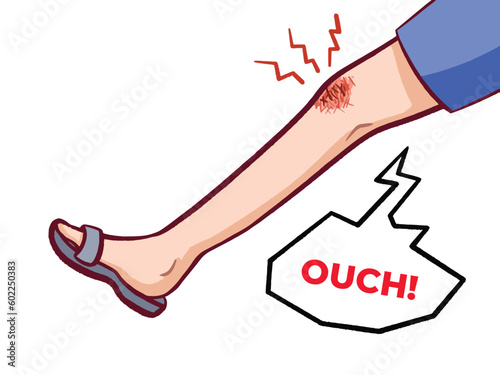 Grazed or wounded and bleeding knee leg vector illustration isolated on horizontal white background. Hurt leg from falling or sport accidents with simple flat art style.