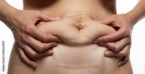 Flabby belly after pregnancy close up, tummy tuck woman waist after gastric bypass photo