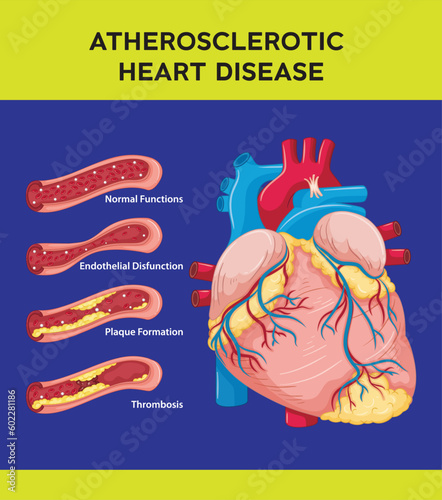 Atherosclerotic heart disease