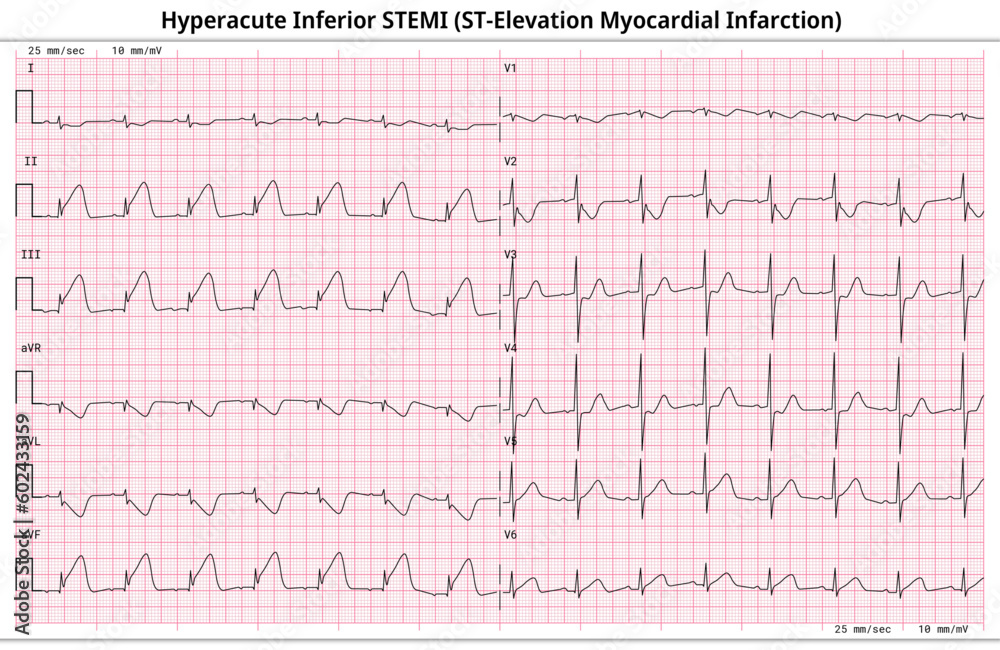 Hyperacute Inferior STEMI (ST-Elevation Myocardial Infarction) - 12 Lead ECG Common Case - 6 Sec/lead - Vectors and Illustrations for Medical Purposes Hyperacute Inferior STEMI (ST-Elevation Myocardial Infarction) - 12 Lead ECG Common Case - 6 Sec/lead - Vectors and Illustrations for Medical Purposes
