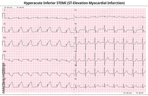 Hyperacute Inferior STEMI (ST-Elevation Myocardial Infarction) - 12 Lead ECG Common Case - 6 Sec/lead - Vectors and Illustrations for Medical Purposes