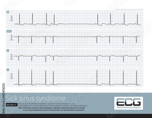 When sinoatrial node pacemaker cells are dysfunctional, one atrial premature contraction can significantly inhibit the function of sinoatrial node, resulting in a long PP interval. photo