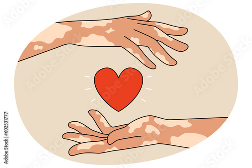 Person with leprosy hold heart