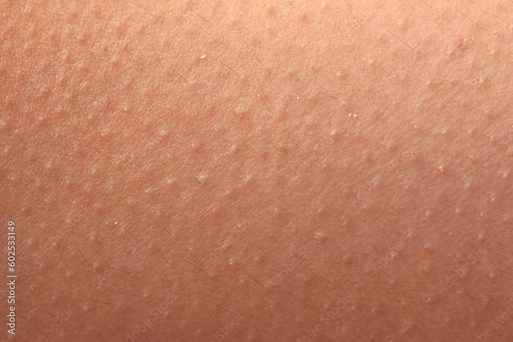 Fototapeta premium skin with cold rash as background.