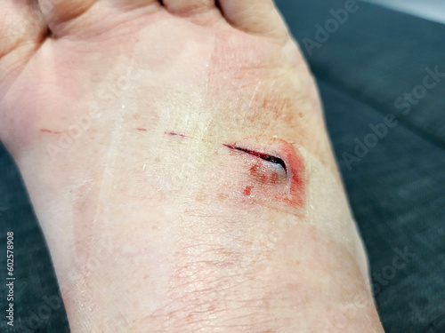 Stingray whip injury causing a laceration across the foot. The wound requires barb removal and a medical wash as these marine animals use their barbed stingers to inject venom into their victims.